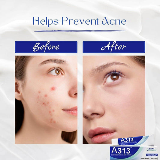 Before and after images showcasing A313 Pommade's effectiveness in preventing acne and revitalizing skin.