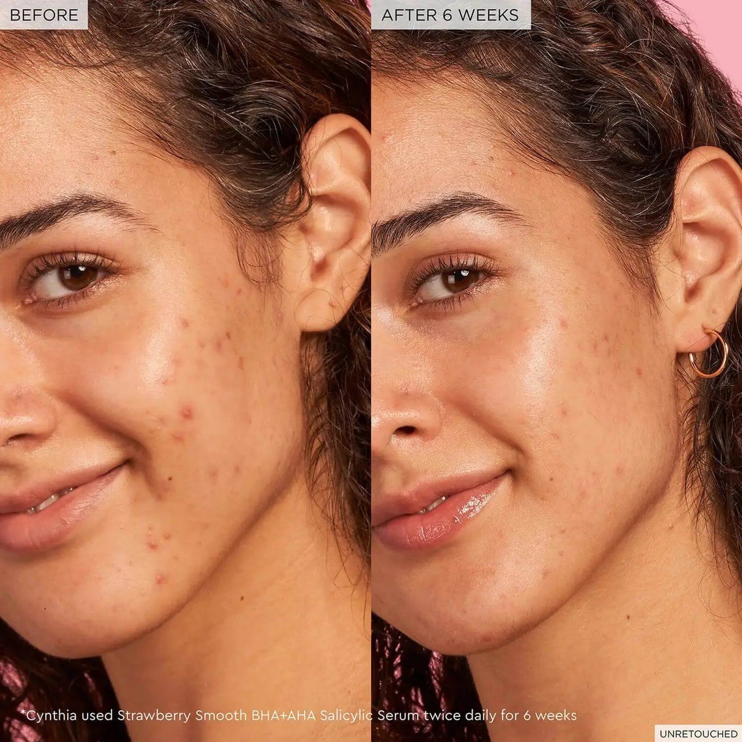 Before and after results of using Glow Recipe Strawberry Smooth BHA+AHA Serum for 6 weeks, showing clearer skin.