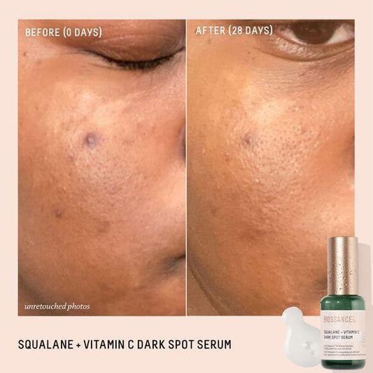 Before and after image showing skin improvements with BIOSSANCE Squalane + Vitamin C Dark Spot Serum after 28 days.