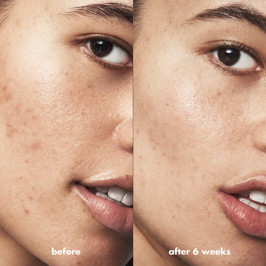 Before and after results of e.l.f Blemish Breakthrough Spot Gel, showing skin improvement over 6 weeks.