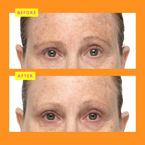 Before and after comparison of a person's face with visible skin texture differences on Drunk Elephant C-firma Fresh Day Serum