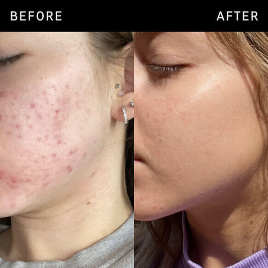 Before and after showing improvement in skin clarity and reduction of breakouts with skincare treatment.