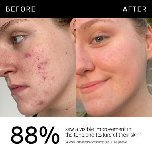 Before and after image showcasing a 88% improvement in skin tone and texture after using a skincare product.