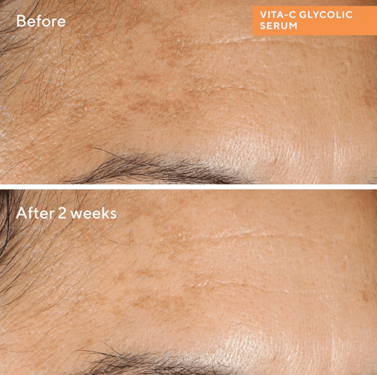 Before and after results of Murad Vita-C Glycolic Brightening Serum showing improved skin texture and radiance.