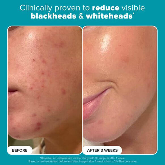 Before and after results of using Paula's Choice 2% BHA Liquid Exfoliant for clearer skin.