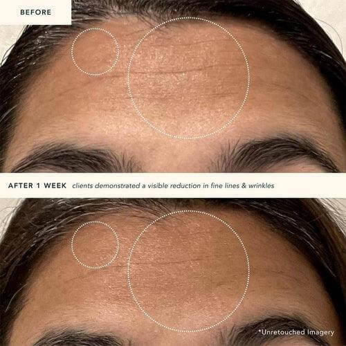 Before and after comparison showing reduction of fine lines and wrinkles after using RANAVAT Restoring Moonseed Treatment.