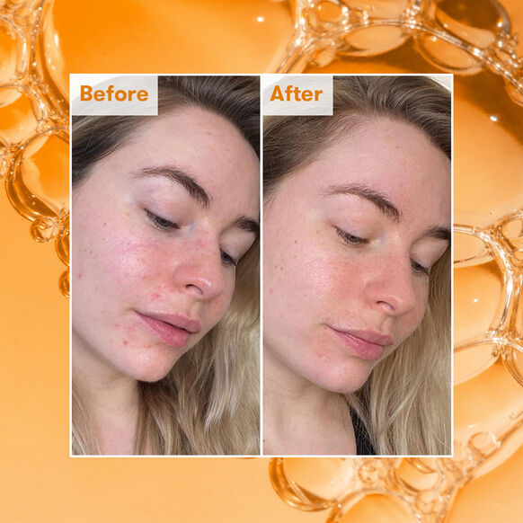 Before and after comparison of a woman's face with Ren skincare product application on an orange background.