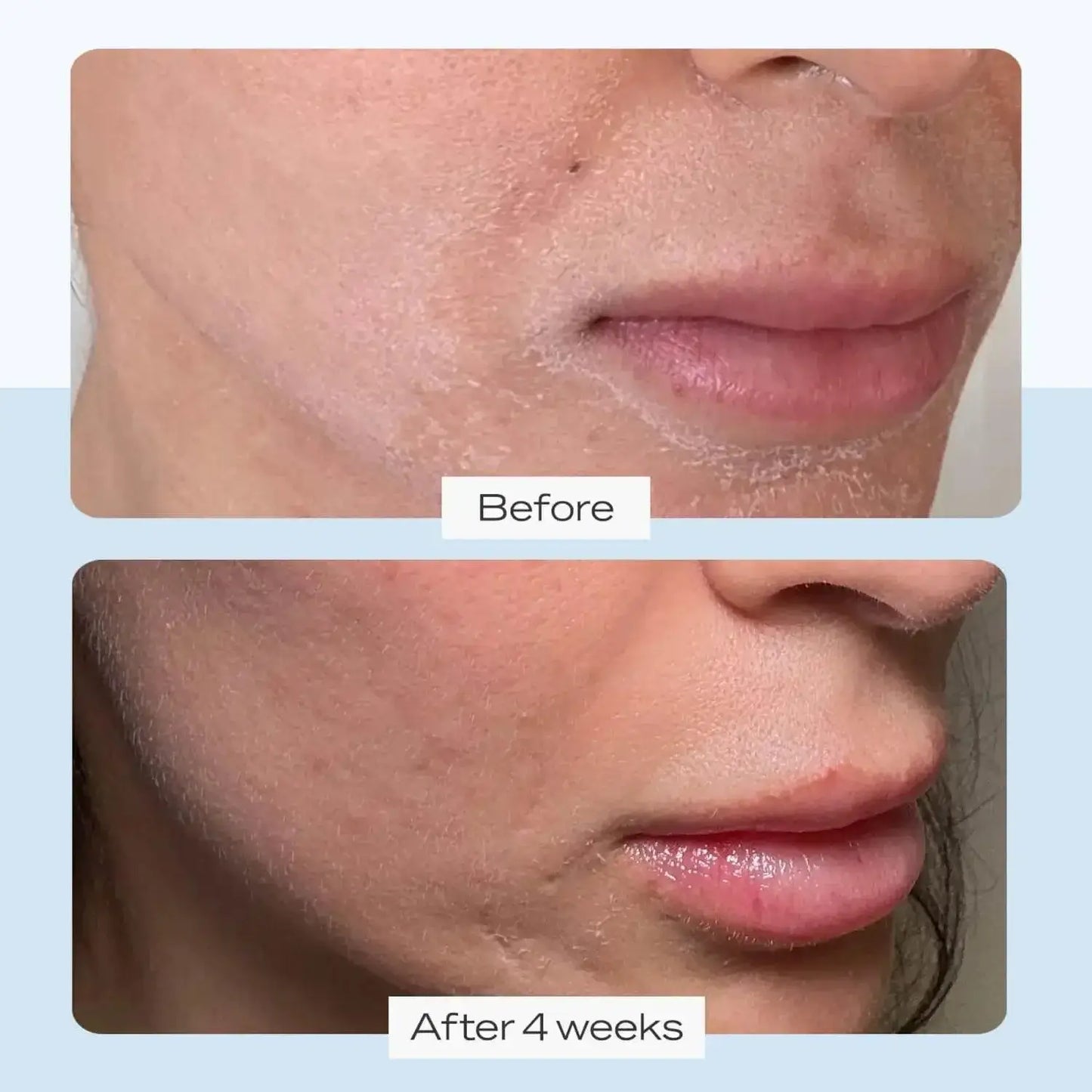 Before and after images showing skin improvement over 4 weeks using First Aid Beauty Ultra Repair Cream.