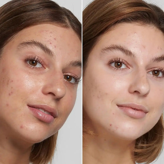 Before and after results showing clearer skin with The INKEY List Salicylic Acid Cleanser.