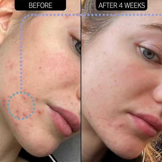 Before and after comparison of skin improvement after using The INKEY List SuperSolutions Blemish Clearing Moisturiser.
