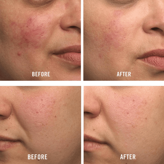 Before and after image showing skin improvement with First Aid Beauty Ultra Repair Hydrating Serum on acne-prone skin.