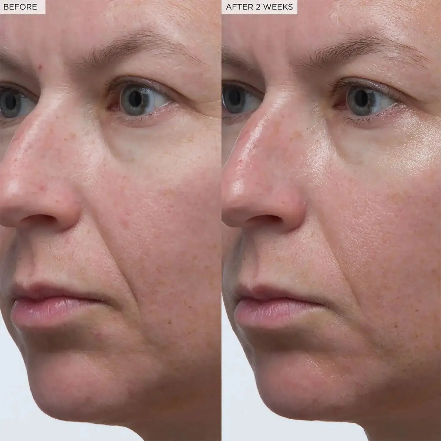 Before and after results of skin improvement using Glow Recipe Plum Hyaluronic Serum over 2 weeks.