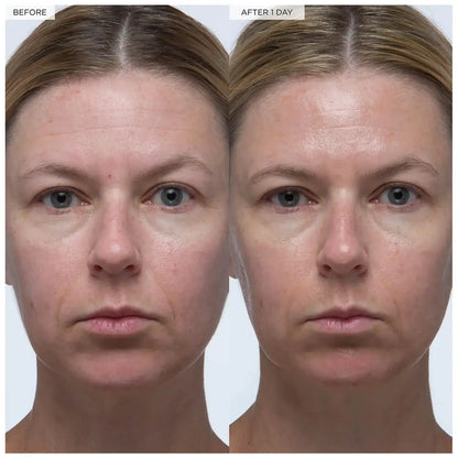 Comparison of facial skin before and after using Glow Recipe Plum Plump Hyaluronic Serum for 1 day.