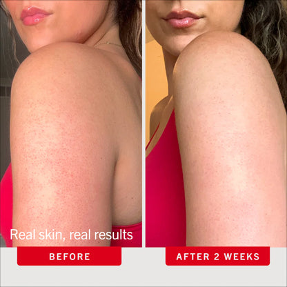 Before and after comparison of a woman's arm with First Aid Beauty text indicating results after 2 weeks.