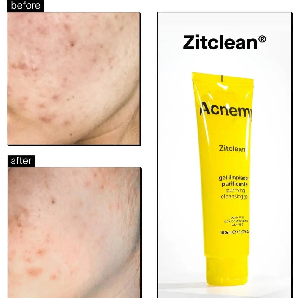 ACNEMY Zitclean® Purifying Cleansing Gel 150ml - The Good Vibes