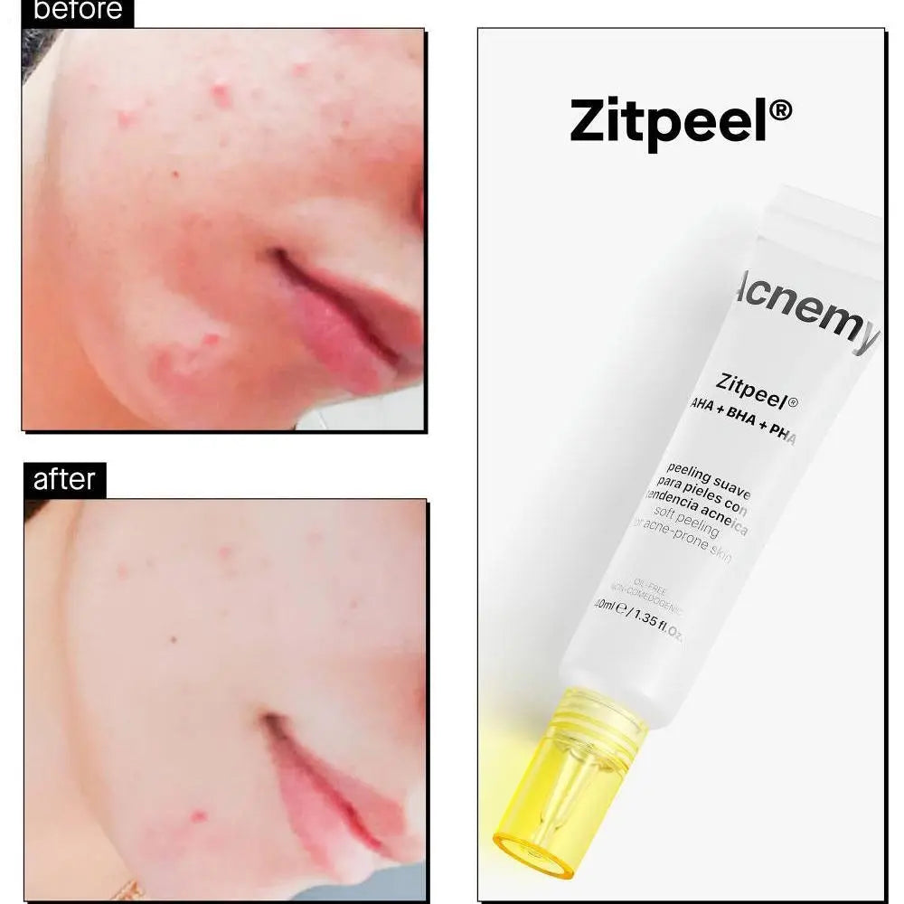 ACNEMY Zitpeel® AHA + BHA + PHA Overnight Treatment 40ml - The Good Vibes