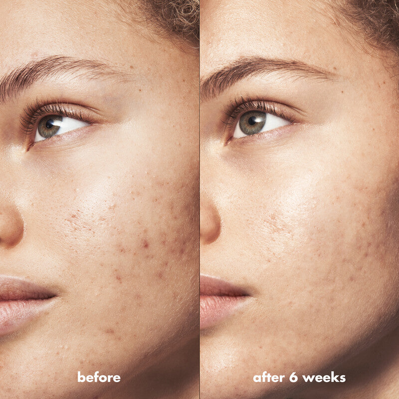 Before and after results of e.l.f Blemish Breakthrough Spot Gel on acne-prone skin over six weeks.