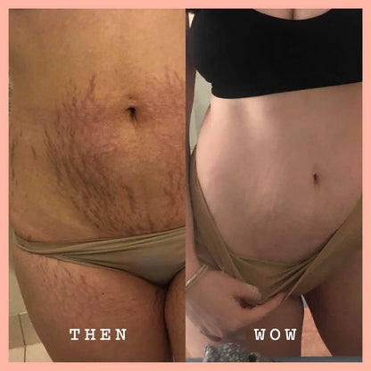 Before-and-after split comparison of a woman's midsection showing stretch marks and skin texture improvement, labeled 'THEN' and 'WOW' on a pink border background.