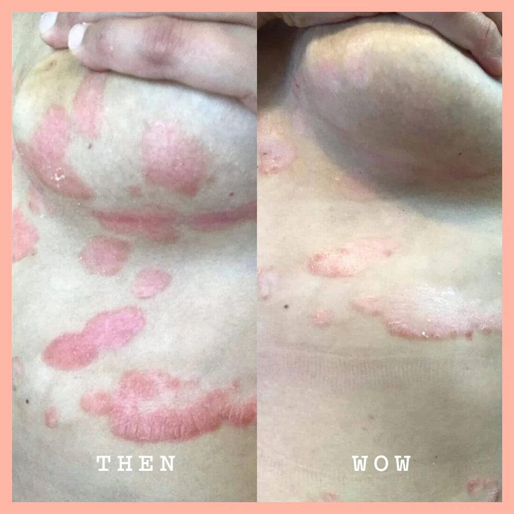 A side-by-side before-and-after style comparison of skin showing pinkish-red rash or erythema on the chest and shoulder area, with the text 'THEN' on the left and 'WOW' on the right, framed by a peach border.