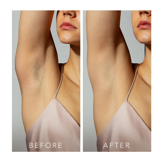 FOREO PEACH 2 go Skin Cooling System - Advanced Hair Reduction IPL Device  - Peach