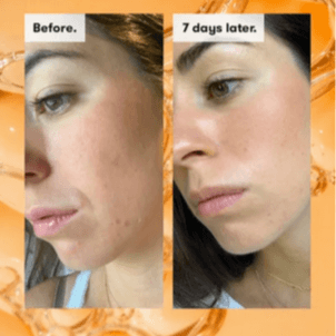 Before and after comparison of skin improvement using REN Clean Skincare AHA Tonic over 7 days.
