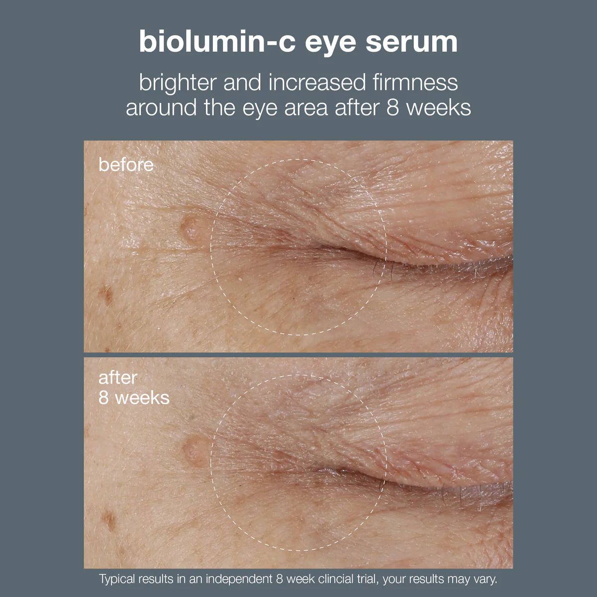Before and after effects of dermalogica biolumin-c eye serum on eye area skin.