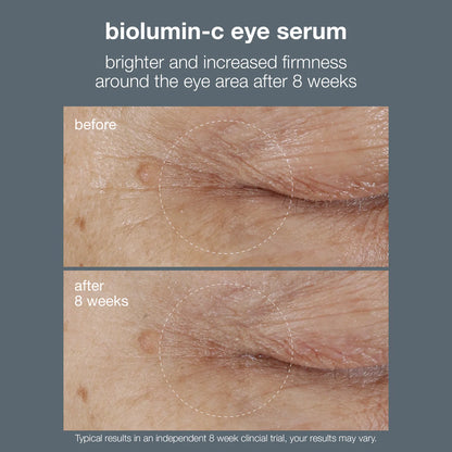 Before and after effects of dermalogica biolumin-c eye serum on eye area skin.