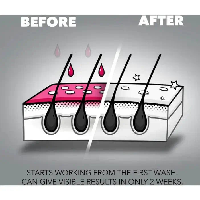 Illustration showing hair follicles with 'Before' and 'After' Nizoral effects on a gray background.