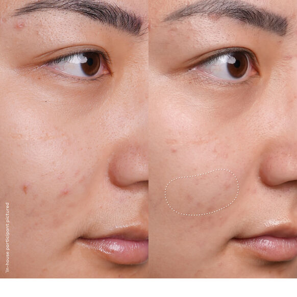 Before and after comparison of a person's face with a focus on the nose area.