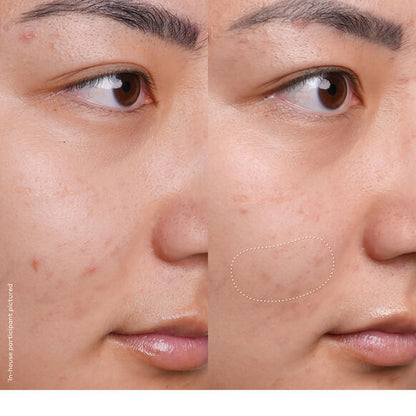 Before and after comparison of a person's face with a focus on the nose area.