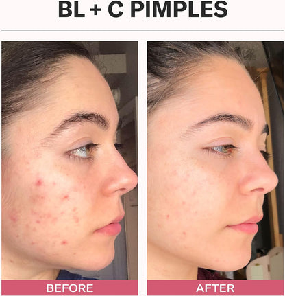 Before and after comparison of a person's face with visible pimple reduction. Odacité