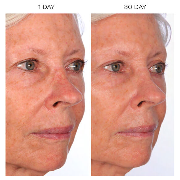 Before and after comparison of a woman's face with visible skin texture changes over 30 days using U Beauty Super Smart Hydrator 15ml.