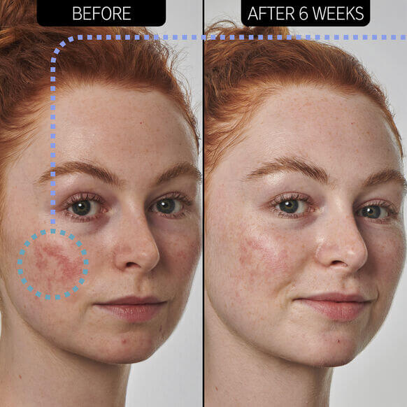 Comparison of skin before and after 6 weeks of using INKEY List Super Solutions 10% Azelaic Acid Serum.