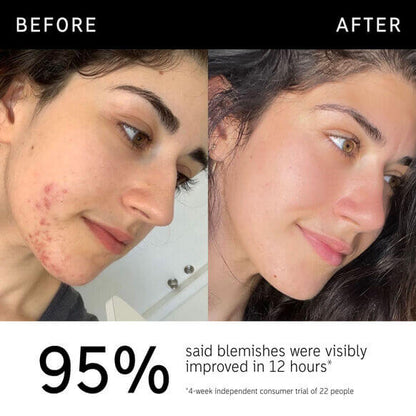 Before and after using The Inkey List Succinic Acid Treatment, showing visible improvement in skin clarity.