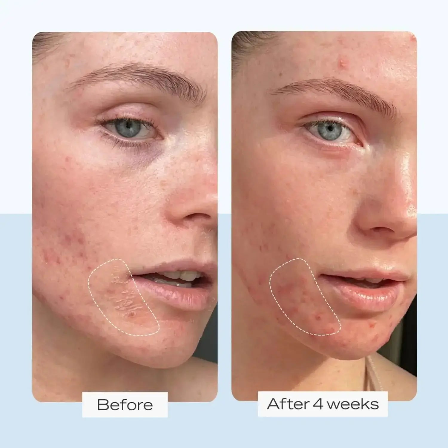 Comparison of skin improvement before and after 4 weeks of First Aid Beauty treatment, showing reduced blemishes and clearer complexion.