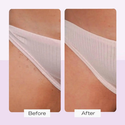 Before and after results of using First Aid Beauty Ingrown Hair Treatment Pads on skin with ingrown hairs.
