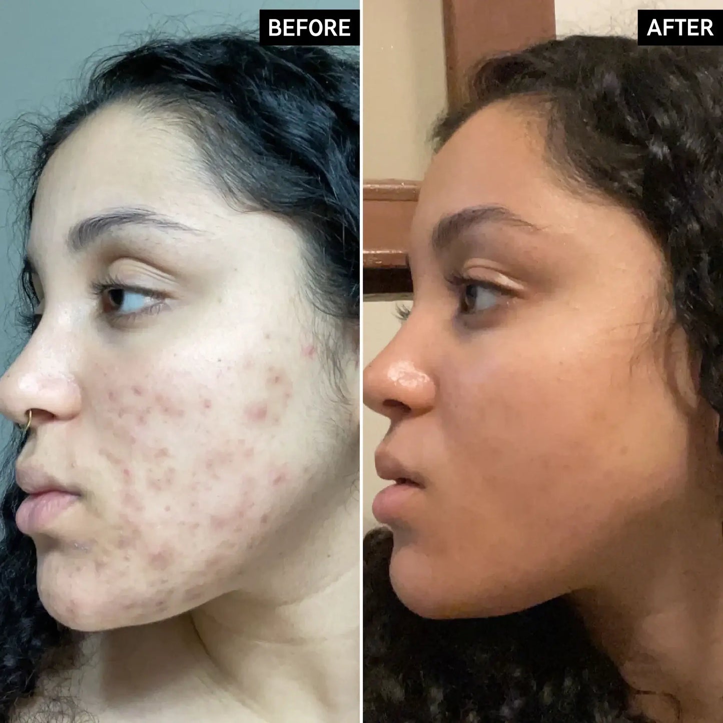 Before and after comparison of acne treatment results on a woman's face, highlighting skin improvement.