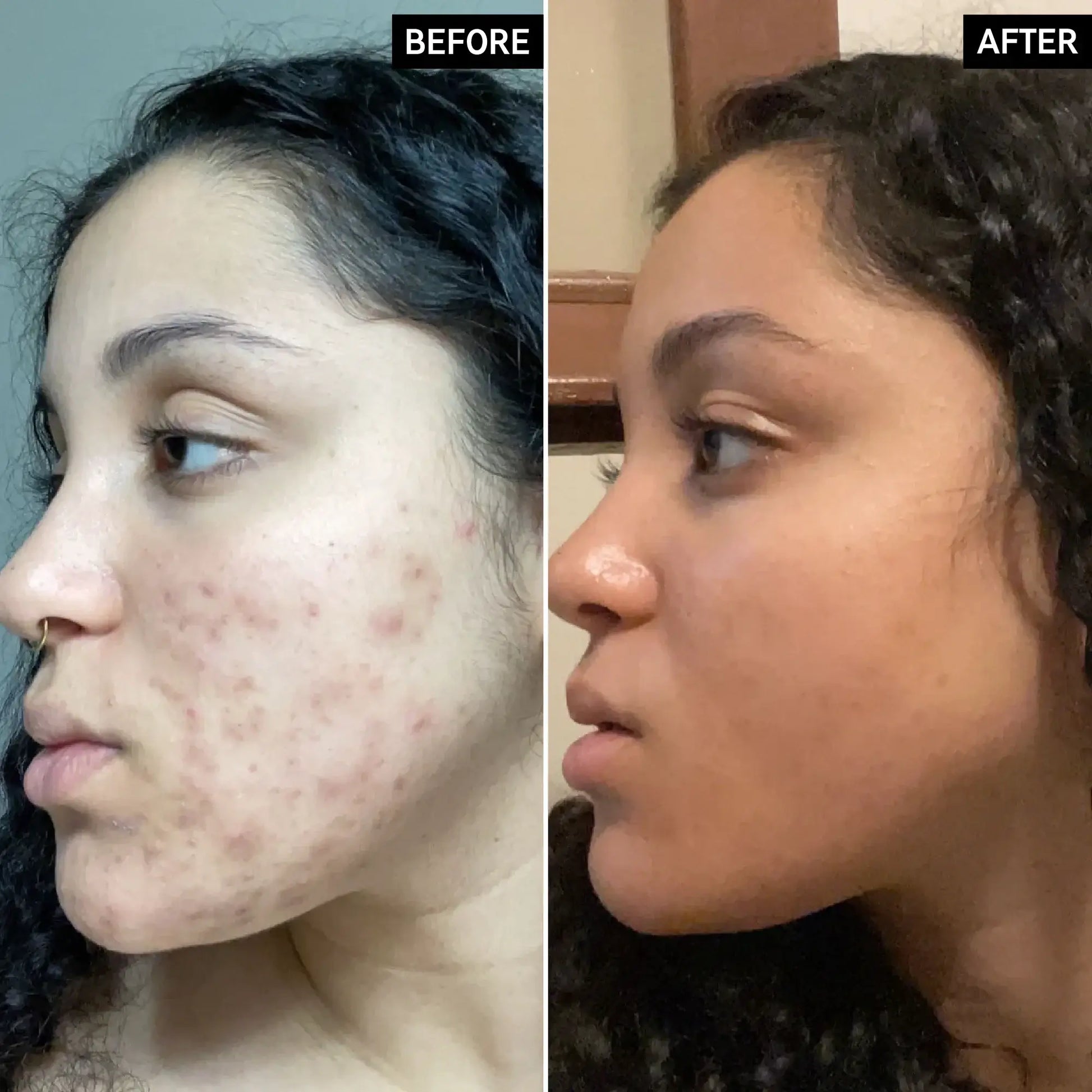 Before and after comparison of acne treatment results on a woman's face, highlighting skin improvement.