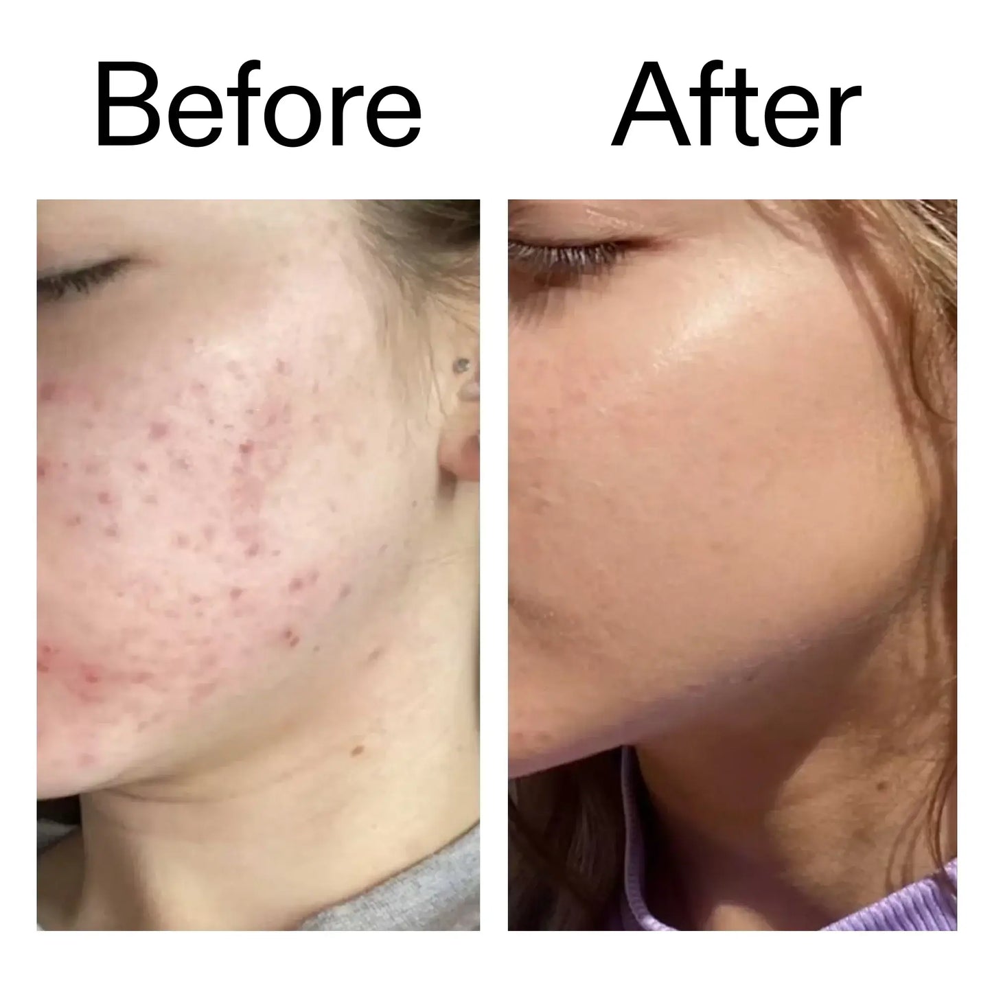 Before and after comparison of skin showing improvement with The INKEY List Beta Hydroxy Acid Serum for clearer complexion.
