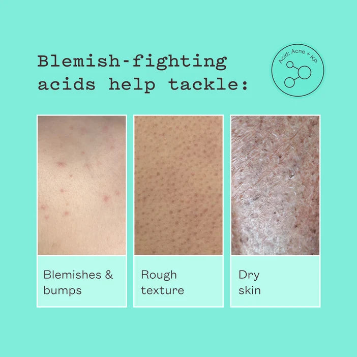 Advertisement for blemish-fighting acids with skin texture examples on a teal background.