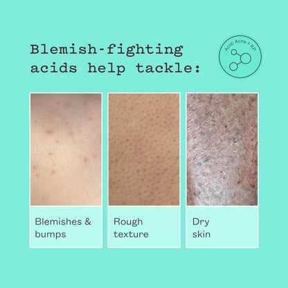 Advertisement for blemish-fighting acids with skin texture examples on a teal background.