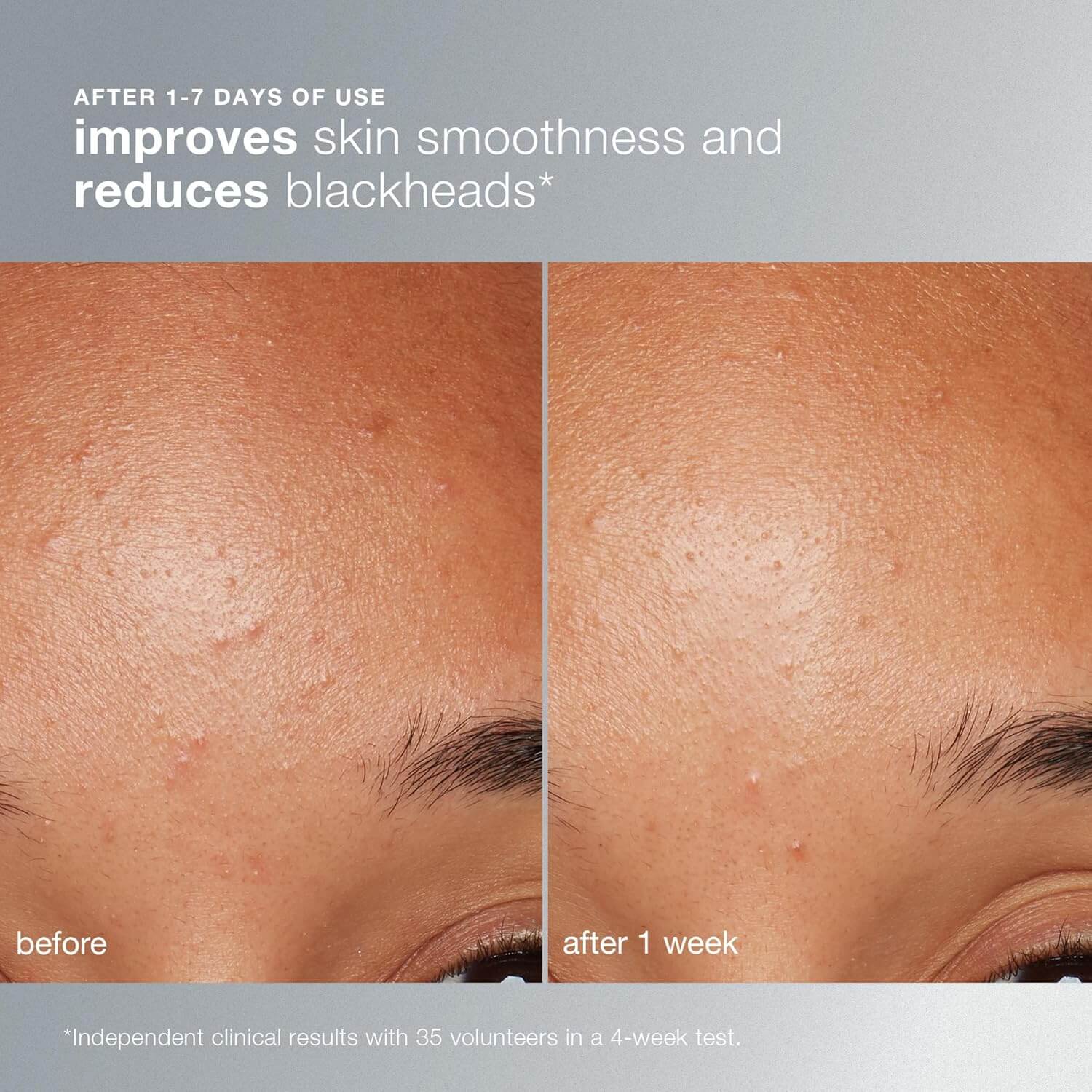 Before and after skin comparison showing improvements in smoothness and blackhead reduction. Dermalogica