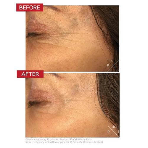 Before and after results of Dr. Levy R3 Cell Matrix Mask on reducing fine lines and improving skin texture.