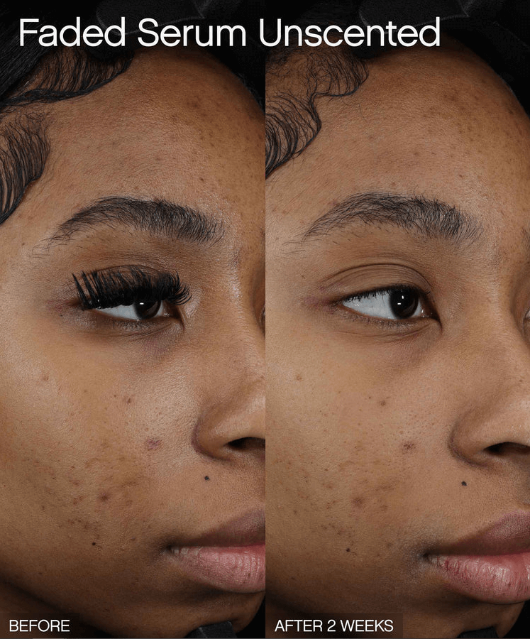 Faded Brightening + Clearing Serum For Dark Spots + Uneven Skintone before and after results after 2 weeks of use.