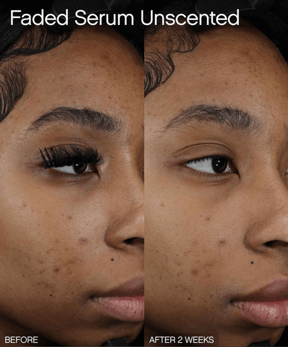 Faded Brightening + Clearing Serum For Dark Spots + Uneven Skintone before and after results after 2 weeks of use.