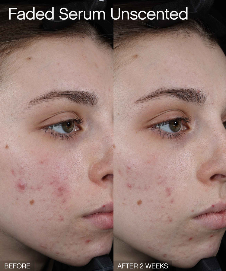 Faded Brightening + Clearing Serum For Dark Spots + Uneven Skintone before and after results on skin.