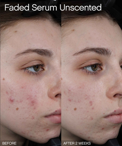 Faded Brightening + Clearing Serum For Dark Spots + Uneven Skintone before and after results on skin.
