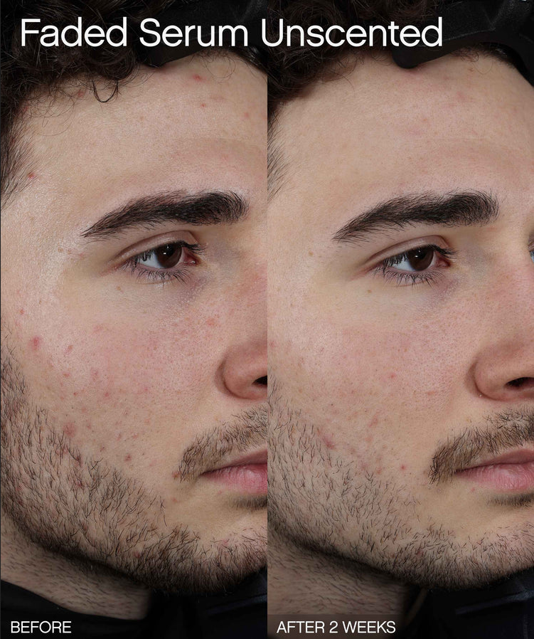 Before and after using Faded Brightening + Clearing Serum For Dark Spots + Uneven Skintone, showcasing skin improvements.