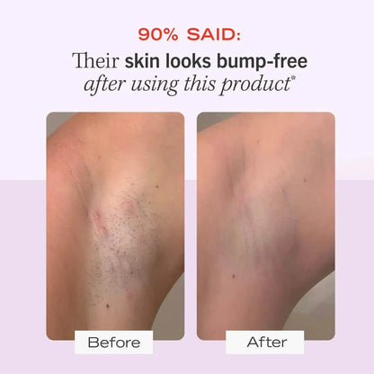 Before and after using First Aid Beauty Ingrown Hair Treatment Pads showing skin that looks bump-free.
