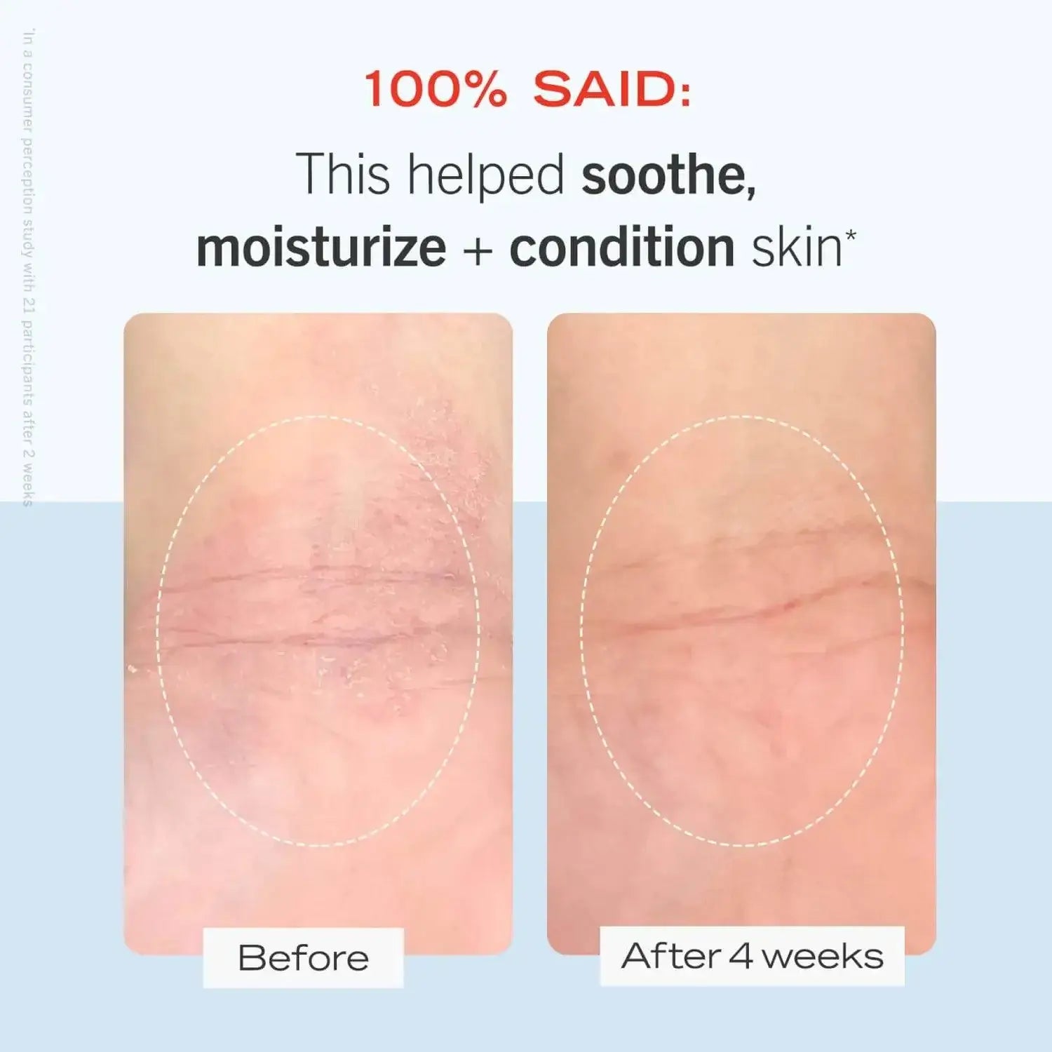 Before and after comparison of skin improvement using First Aid Beauty Ultra Repair Cream after 4 weeks.